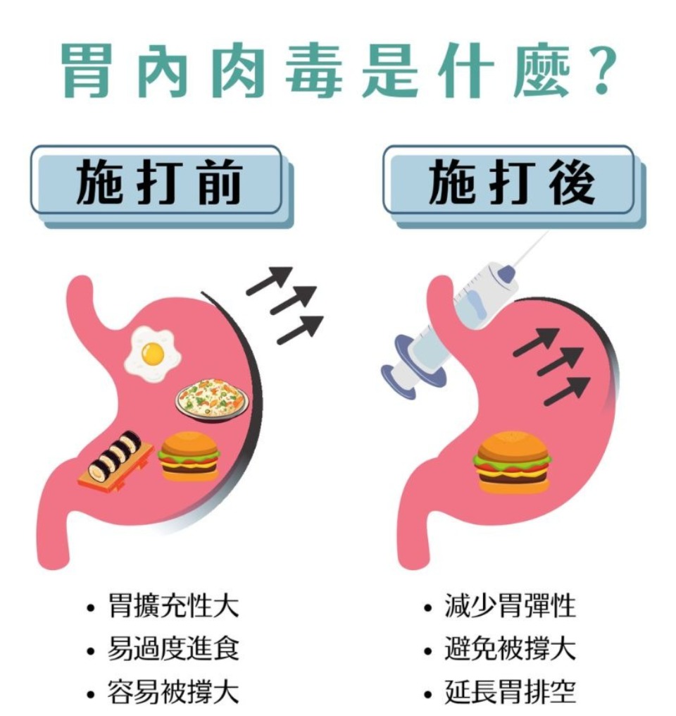 上杉診所胃肉毒減重療程與舒眠胃鏡操作